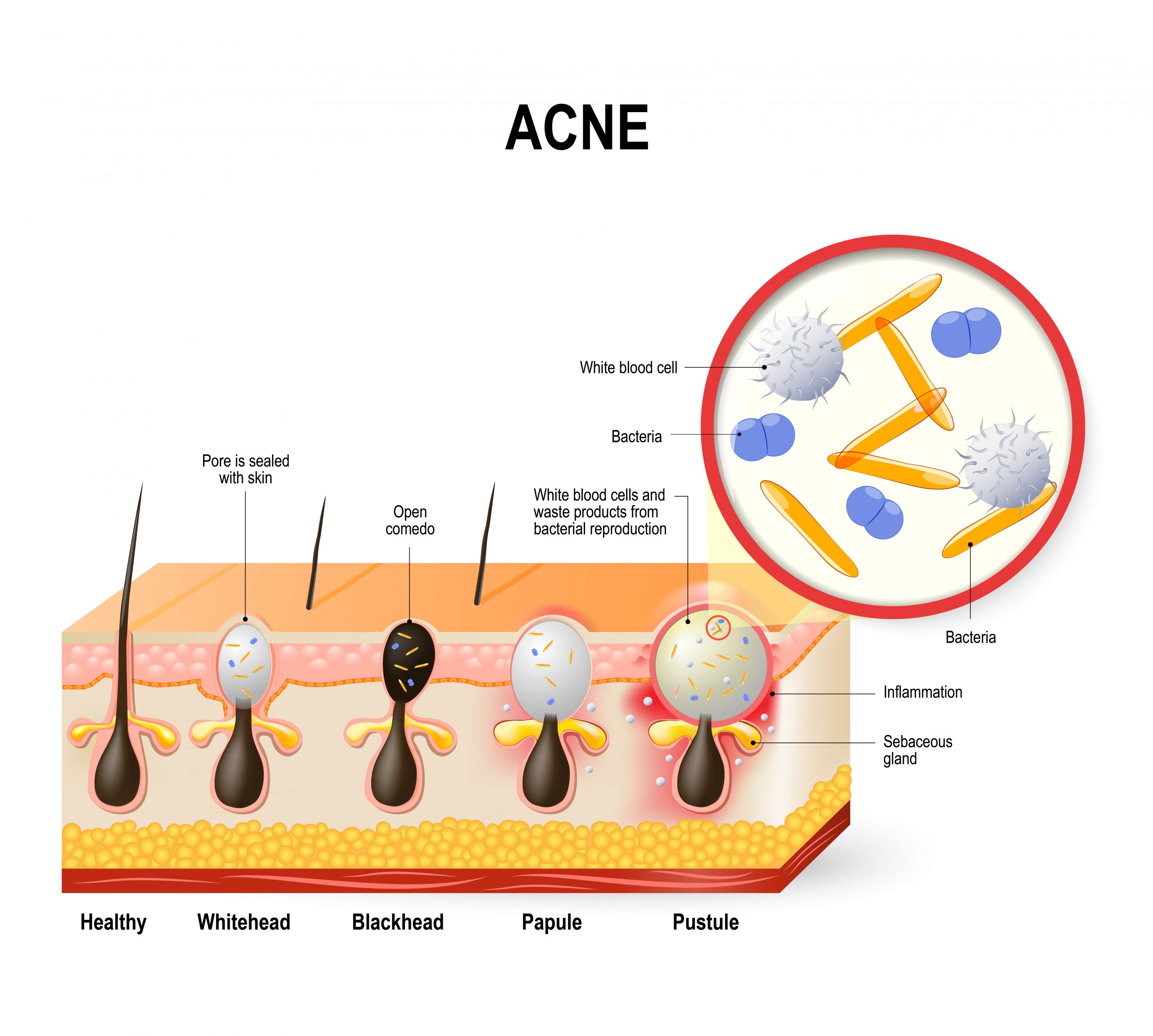 Acne huid optimaal verzorgen